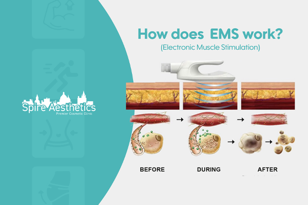 EMS treatment for post pregnancy weight loss treatment Harwich