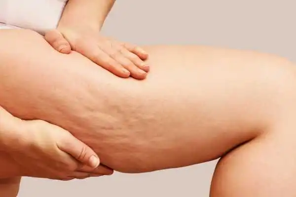 Image of woman showing leg with cellulite Harwich