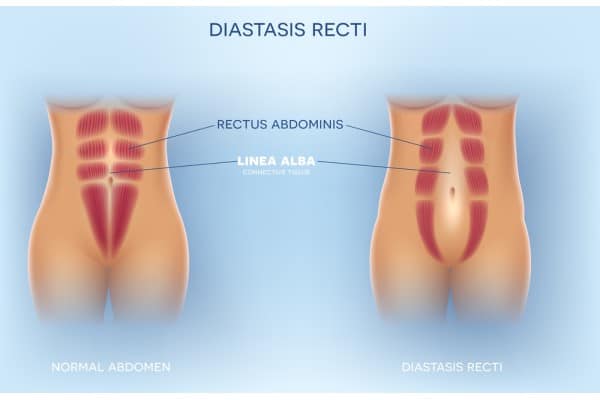 What Non-Surgical Options Are Available for Diastasis Recti Harwich?