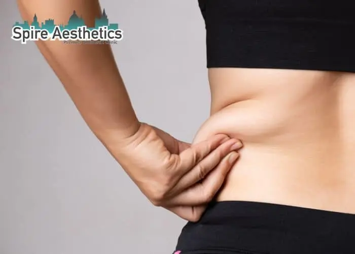 Image of woman pinching fat on their hips Harwich. Fat Freezing treatment