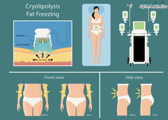 Image of diet and fat freezing combined for best results for Spire Aesthetics Harwich