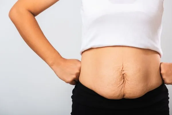 Image of a woman's stomach after weight loss with sagging skin following a gastric band Harwich