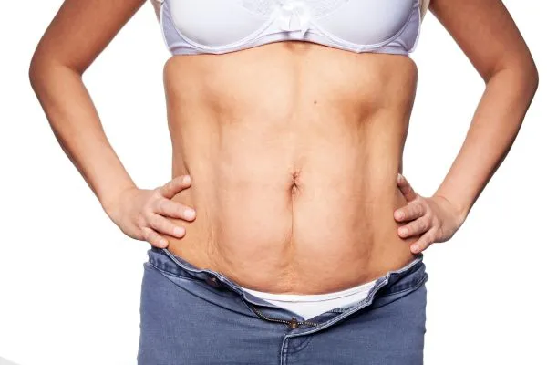 sagging skin on woman's stomach after weight loss injections Harwich