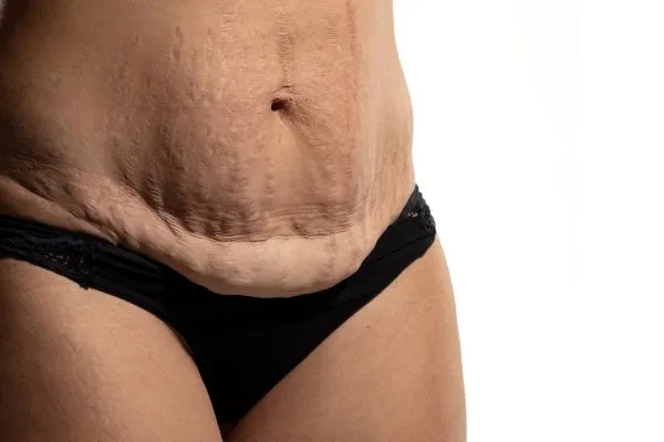 Image of womans stomach after weight loss injections Harwich showing saggy skin