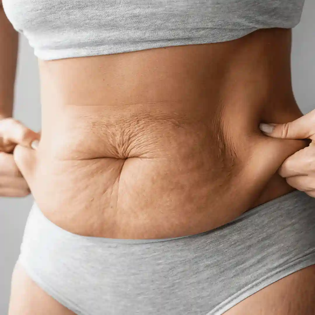 Is It Normal to Have Loose Skin After Pregnancy Harwich?