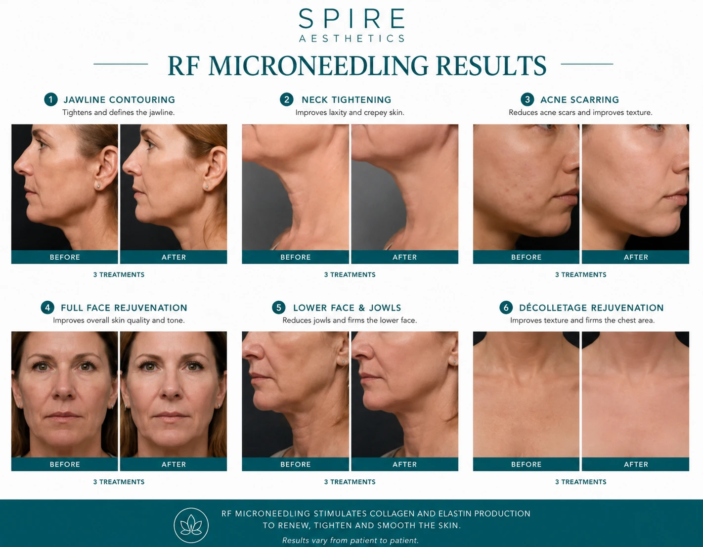 RF Microneedling Skin tightening Harwich results