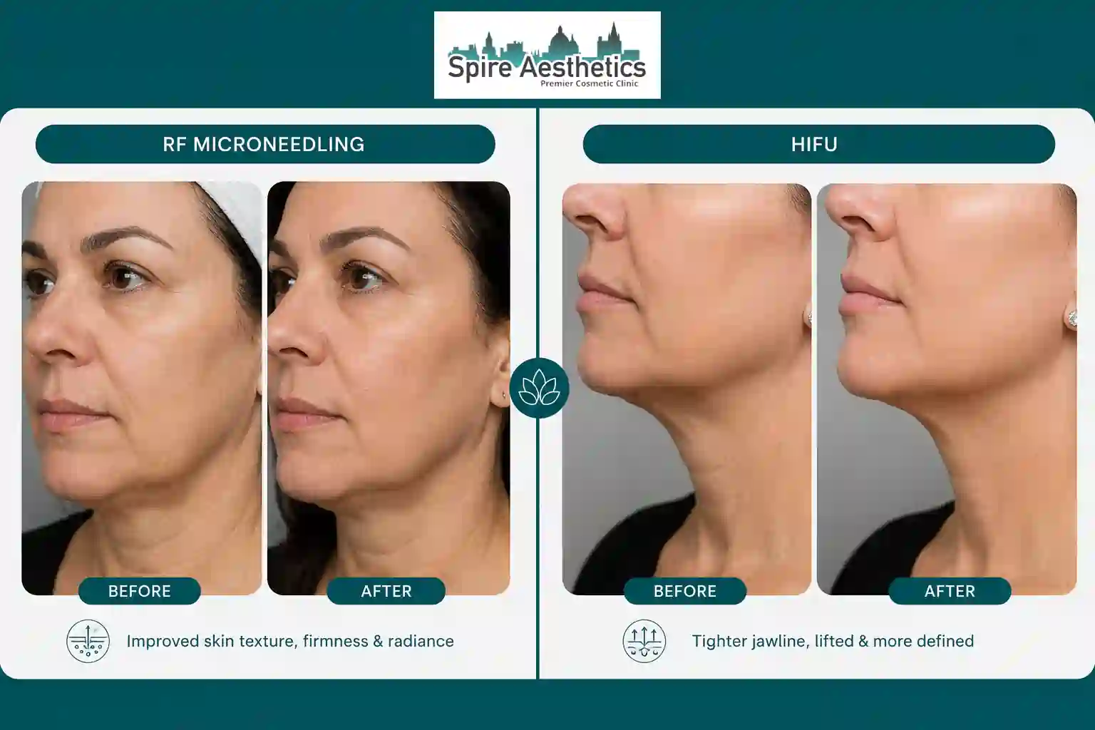 Can RF Microneedling and HIFU Be Combined Harwich?