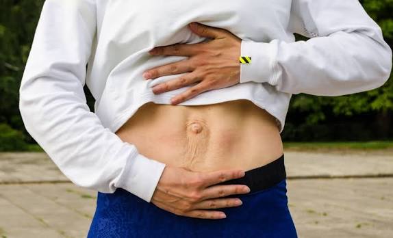 When Could Diastasis Recti Be the Missing Piece of the Puzzle Harwich?