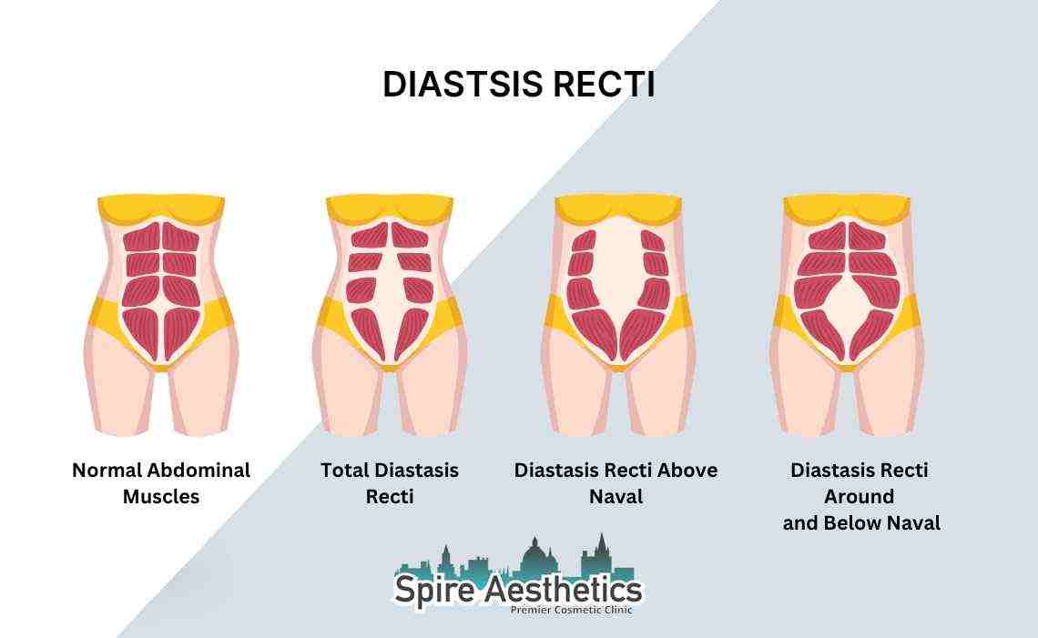 Is Non-Surgical Diastasis Recti Treatment Right for You? Common Concerns Answered Harwich